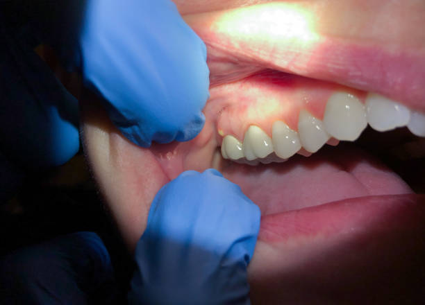 Best Knocked-Out Tooth (Avulsed Tooth) Treatment in Dayton, MN