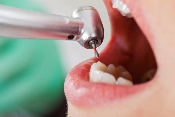 Best Broken or Chipped Tooth Repair in Dayton, MN